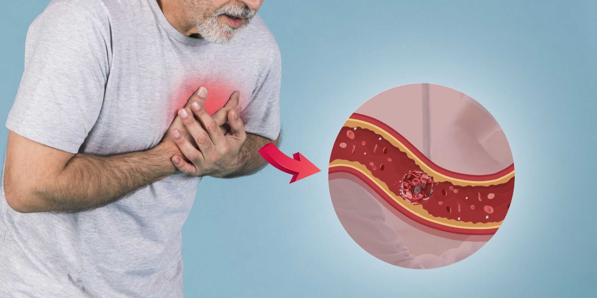 muvalaplin per trattare lipoproteina (a)